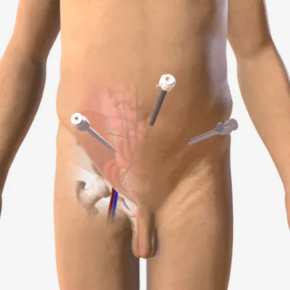 Βουβωνοκήλη Λαπαροσκοπική - hernia laparoscopy