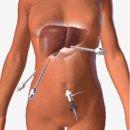 gallbladder laparoscopic - λαπαροσκοπική χολοκυστεκτομή
