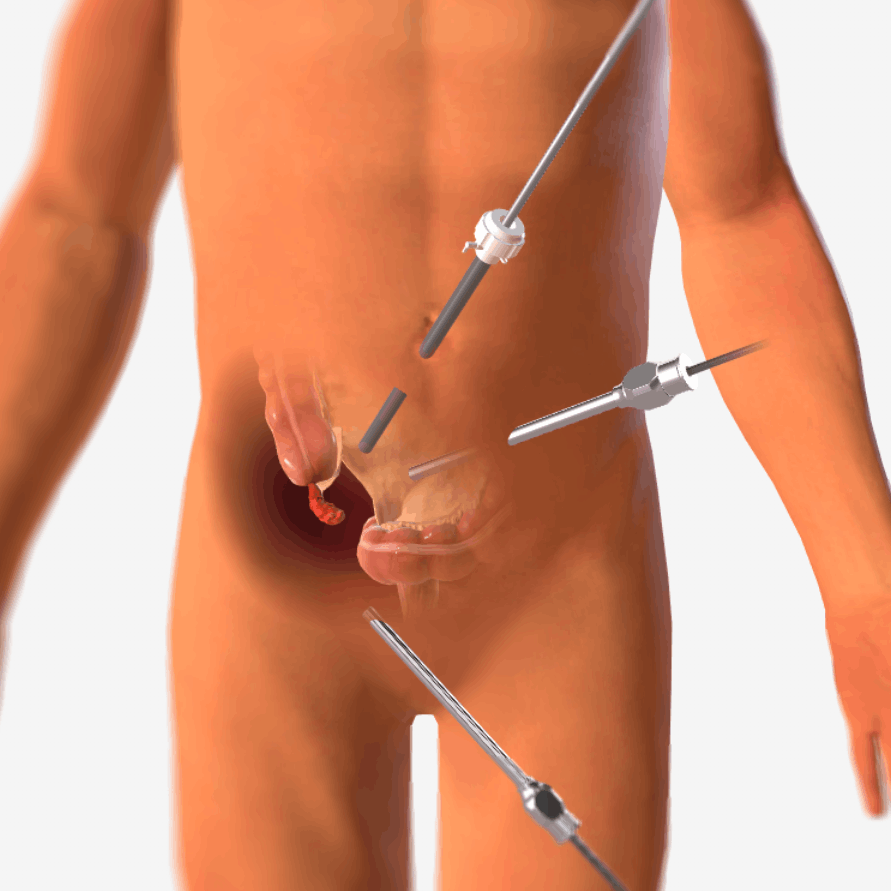 Λαπαροσκοπική Σκωληκοειδεκτομή. Laparoscopic Appendectomy